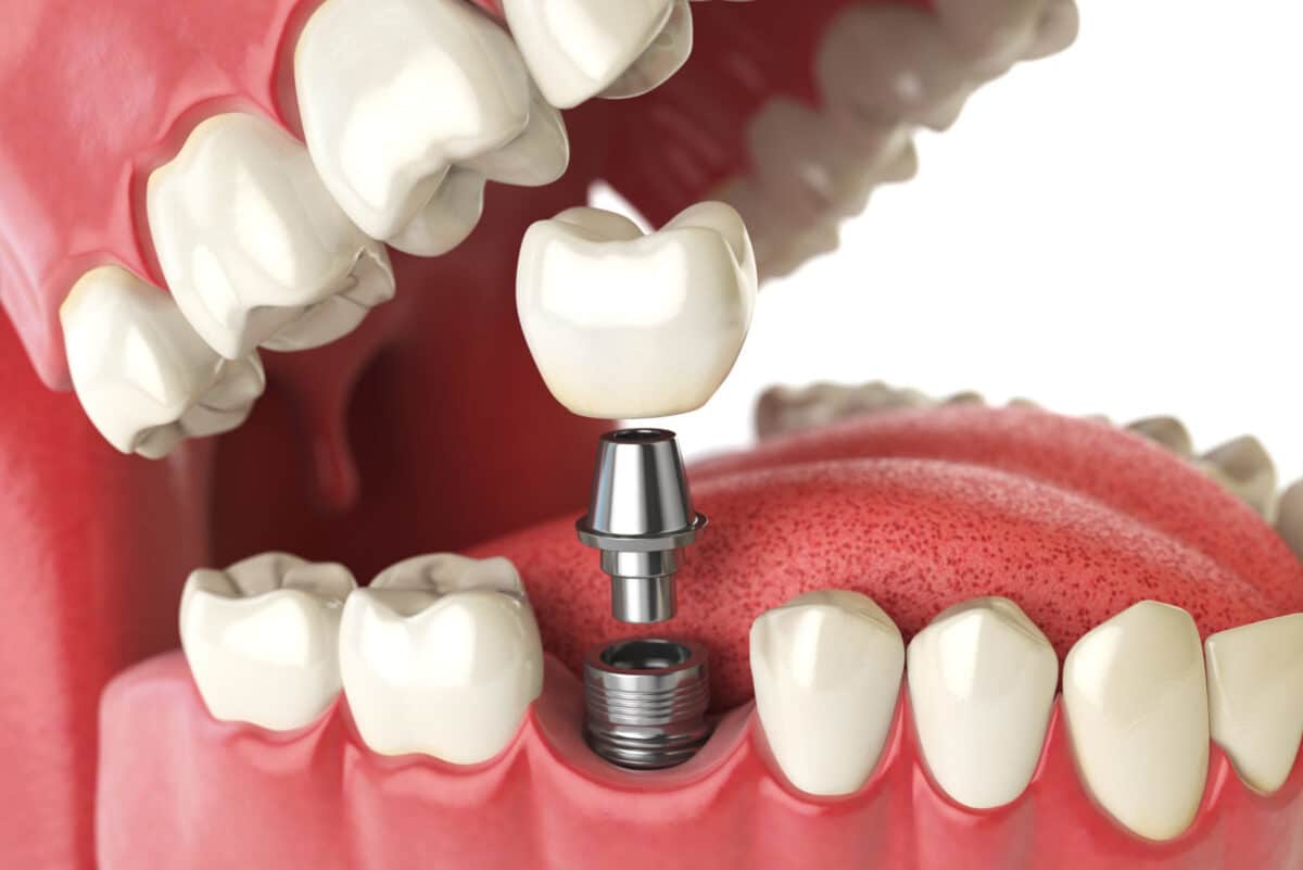 รากฟันเทียม Dental Implant