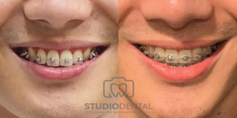 จัดฟันยิ้มสวย