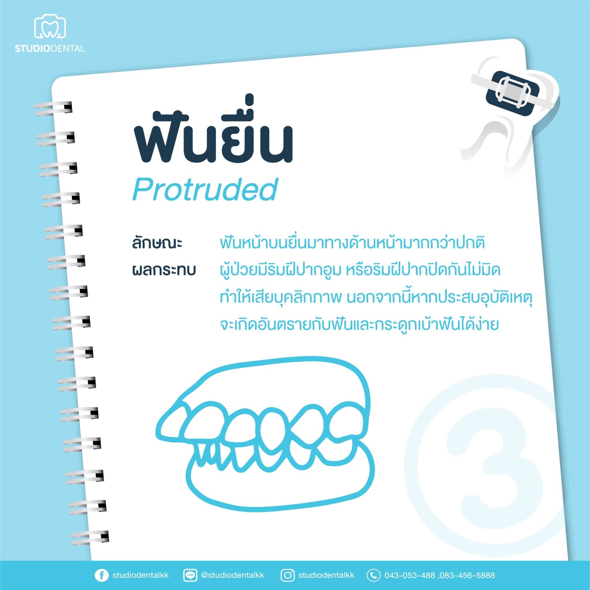 ฟันยื่น